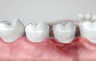 โรคเหงือก เหงือกร่น ปริทันต์ เหงือกอักเสบ