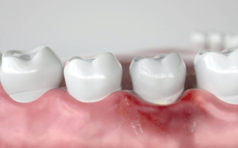 โรคเหงือก-เหงือกร่น-ปริทันต์-เหงือกอักเสบ-770x480