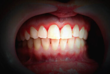 Mouth with bleeding gums on a dark background. Close up.