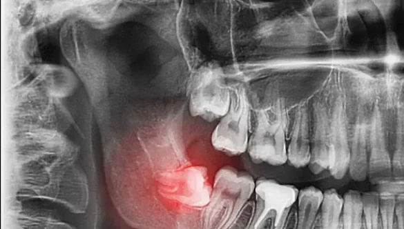 เผยข้อดี ของการจัดฟันในเด็ก