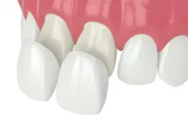 Veneer วีเนียร์