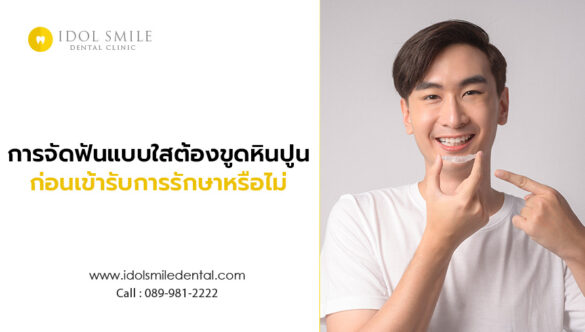 การจัดฟันแบบใส ต้องขูดหินปูนก่อนเข้ารับการรักษาหรือไม่