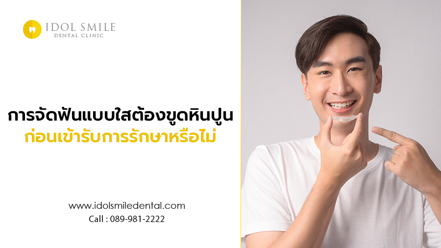 การจัดฟันแบบใส ต้องขูดหินปูนก่อนเข้ารับการรักษาหรือไม่