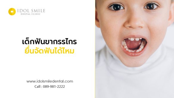 เด็กฟันขากรรไกรยื่นจัดฟันได้ไหม